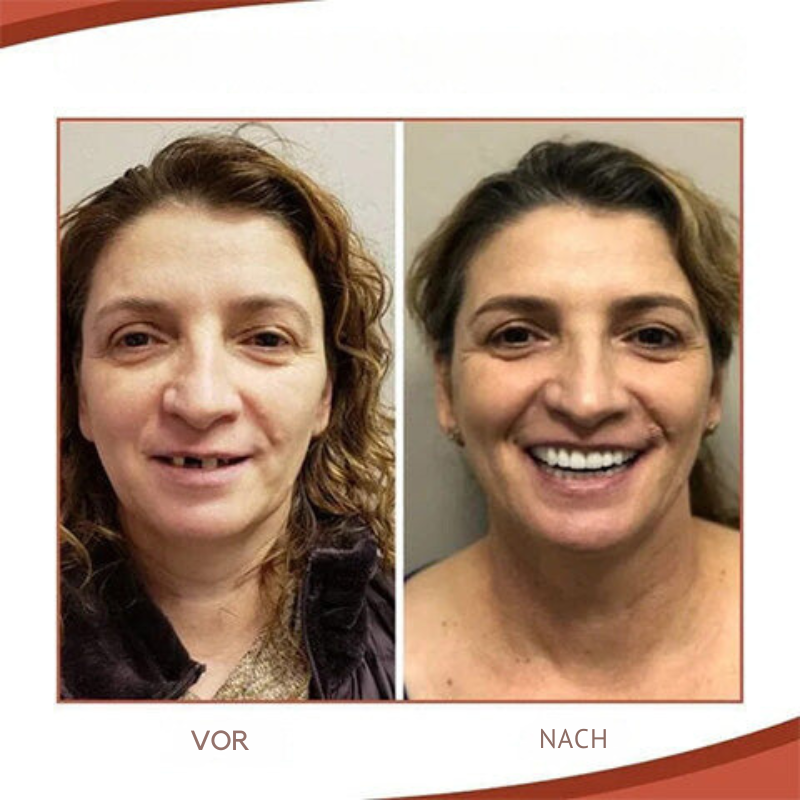 Set de prótesis de silicona biocompatible GlowSmile para un ajuste sin dolor y una sonrisa natural