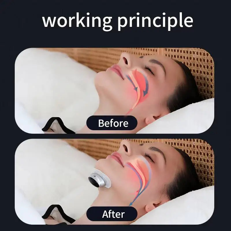 Electric Anti-Snoring Device for Peaceful Sleep